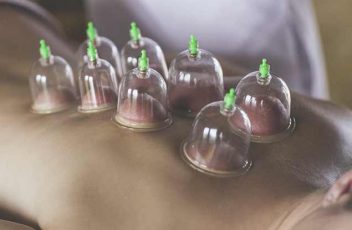 cupping therapy